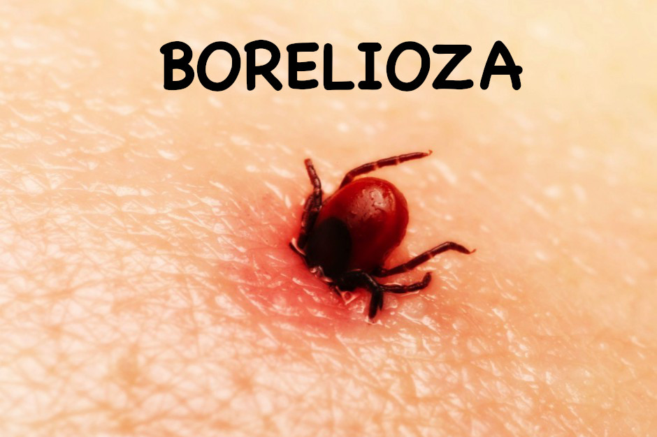 Borelioza